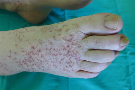 Granulomatous Pigmented Purpuric Dermatosis Bmj Case Reports