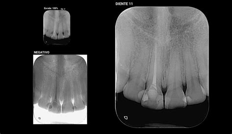 Radiografía Periapical Dx Diagnostico Dental