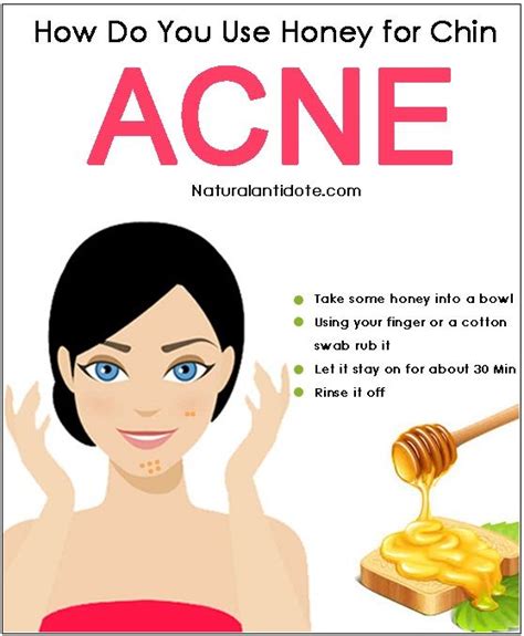 How To Treat Acne Using Honey Howtoremvo