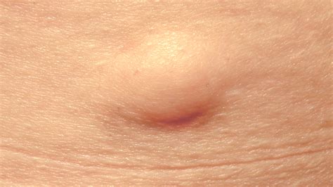 Lumps And Bumps Removal £300 Free Consultation
