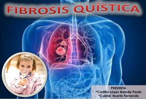 Fibrosis Quísitica