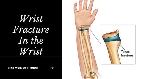 Wrist Buckle Fracture Symptoms And Healing Time Fitoont