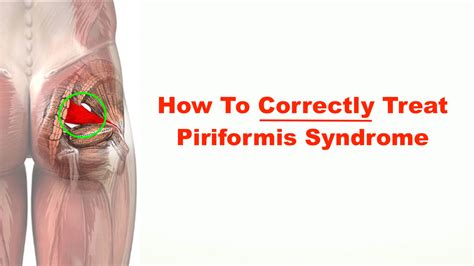 How To Correctly Treat Piriformis Syndrome Squat University