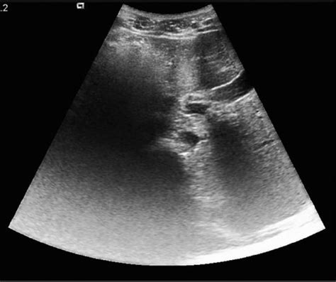 Ultrasonographic Image Showing Left Hypochondrium Download Scientific