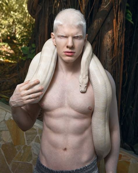Albinism nude фото