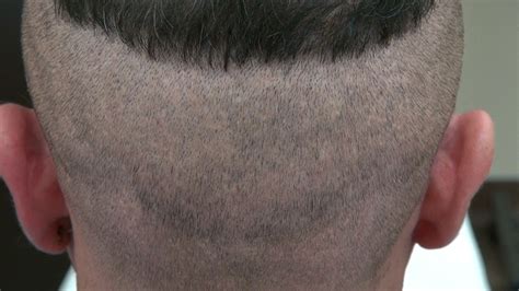 Fue Hair Transplant Scar In Donor Area Dr Diep In San Francisco