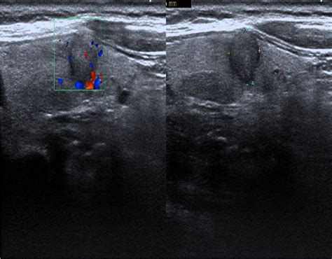 Figure 1 From Ultrasonographic Characteristics Of Medullary Thyroid