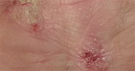 Dermatite Atopica I Principali Rimedi Naturali