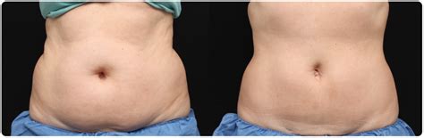Removing Stubborn Belly Fat Takes More Than Exercise