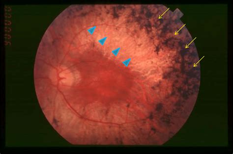 Fundoscopic Examination Of The Retina Shows The Typical Retinal