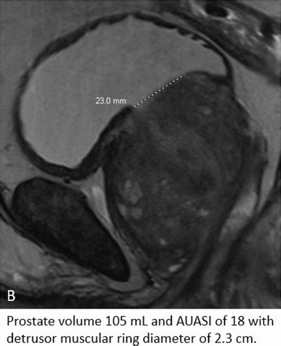 Mp24 03 Bladder Detrusor Muscular Ring Size On Magnetic Resonance