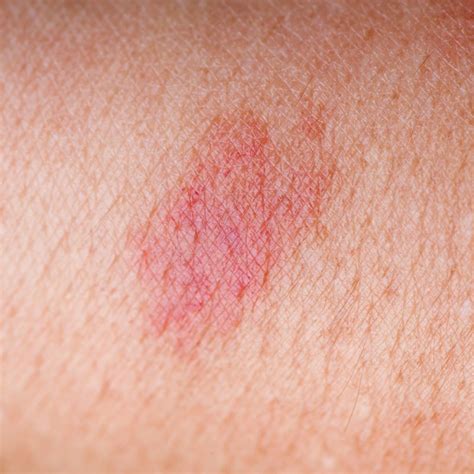 Flat Red Spots On Skin