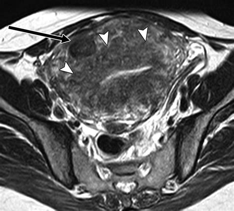 Mri Characteristics Of The Uterine Junctional Zone From Normal To The