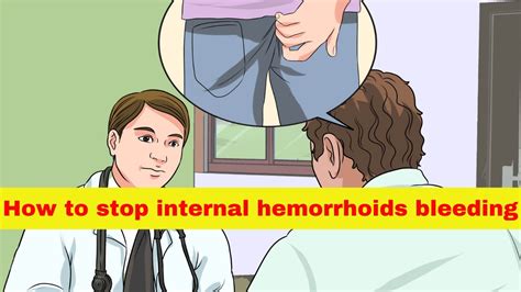 How To Stop Internal Hemorrhoids Bleeding Naturally At Home YouTube