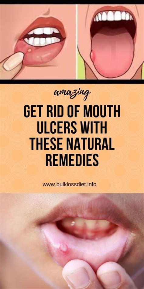 Get Rid Of Mouth Ulcers With These Natural Remedies In 2020 Health