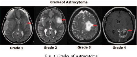 Figure 3 From Brain Tumor Types And Grades Classification Based On