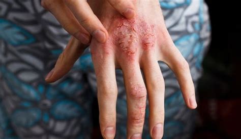 What Is Dermatitis