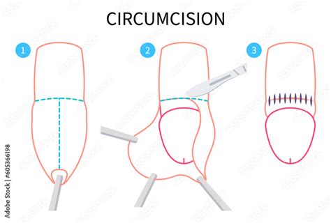Vecteur Stock Circumcision Paraphimosis For Phimosis Swelling Of