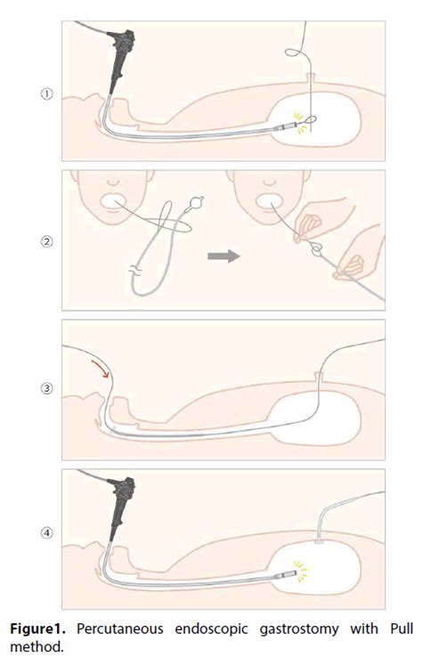 Percutaneous Endoscopic Gastrostomy