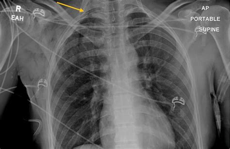 Fused First And Second Right Rib And Bilateral Cervical Rib Chest