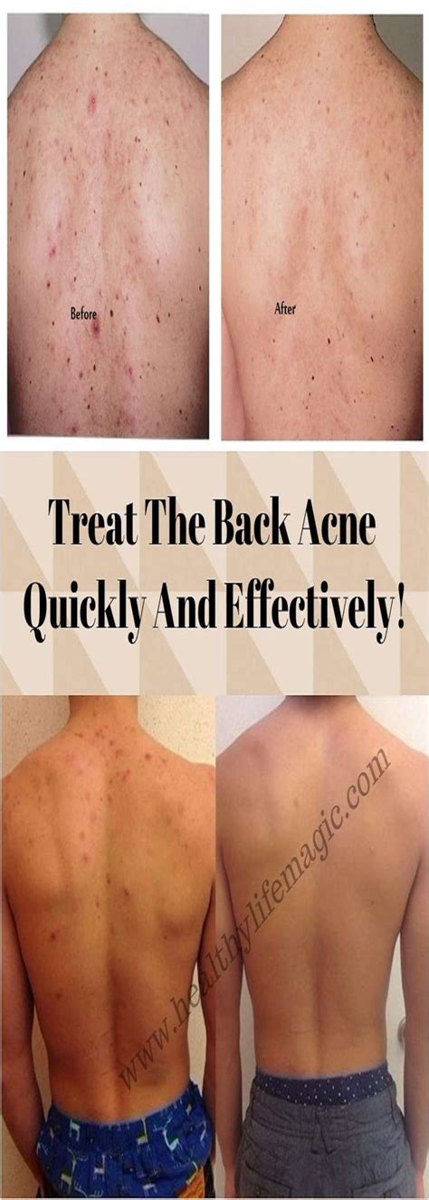 No Longer Struggle With Embarrassing Acne Health And Skin Care Back