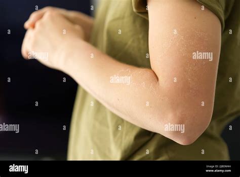 Girl With Sunburnt Shoulders Hi Res Stock Photography And Images Alamy