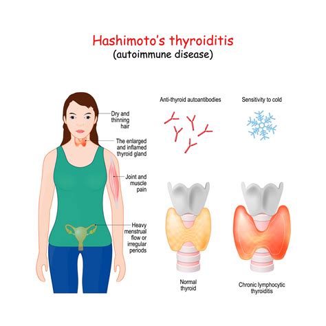 Hashimoto Disease Medic Drive