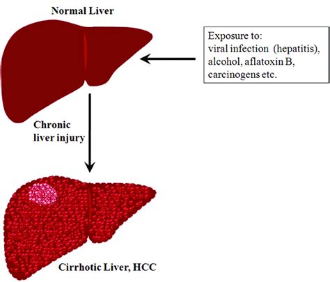 Most relevant best selling latest uploads. A schematic representation showing the transformation of normal liver... | Download Scientific ...