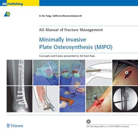 Minimally Invasive Plate Osteosynthesis Mipo Concepts And Cases