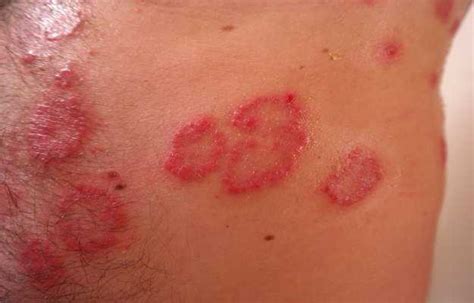 What Is Erythema Multiforme