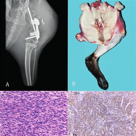 Pdf Fibrosarcoma Arising After Femur Osteosynthesis With Pin And