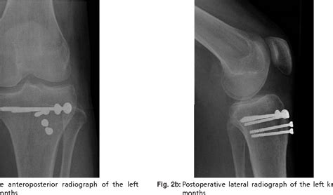 Table I From Combined Avulsion Fracture Of The Tibial Tuberosity And