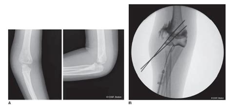Distal Humerus Fractures Obgyn Key