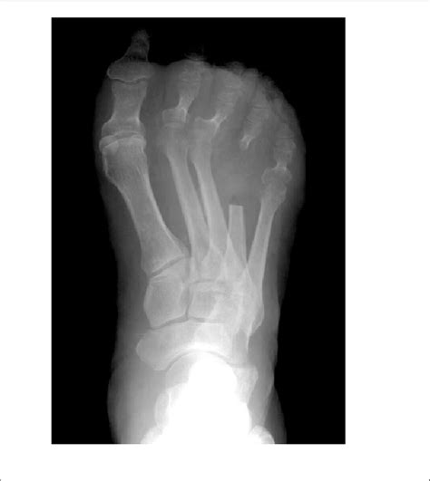 Postoperative X Ray After Fourth Metatarsophalangeal Joint Resection