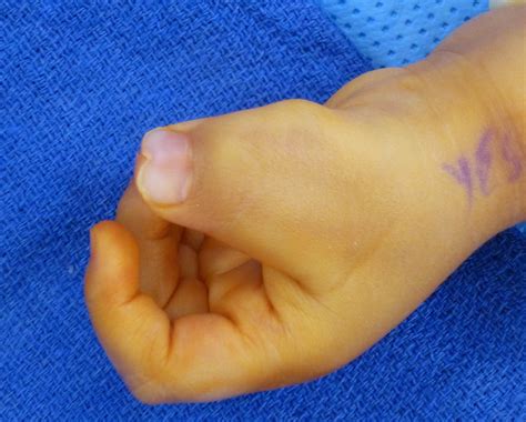 Central Polysyndactyly Congenital Hand And Arm Differences