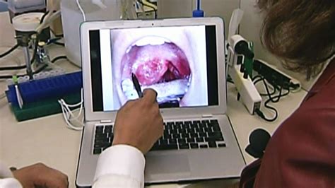dramatic increase in hpv related mouth throat cancers among canadian men report ctv news
