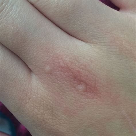 Maybe you would like to learn more about one of these? Pickeligen/ Bläschen an Händen und Füßen? (Haut, Pickel ...