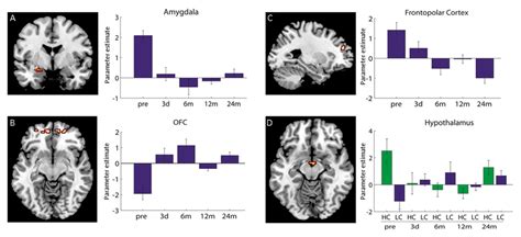 Imaging Data A Left Coronal View Of Amygdala Activation For