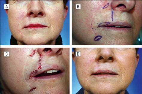 Outcomes Following V Y Advancement Flap Reconstruction Of Large Upper