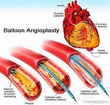Pictures of A Balloon Angioplasty Is Used To
