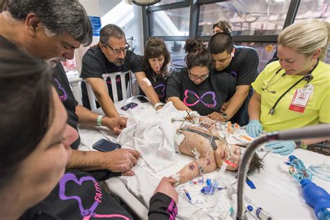 Conjoined Twins Conjoined Twins Knatalye And Adeline Mata Separated In Texas Pictures Cbs News