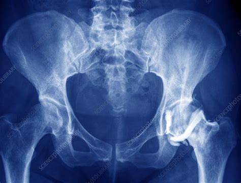 Healthy Hip Joint X Ray Stock Image C0096774 Science Photo Library