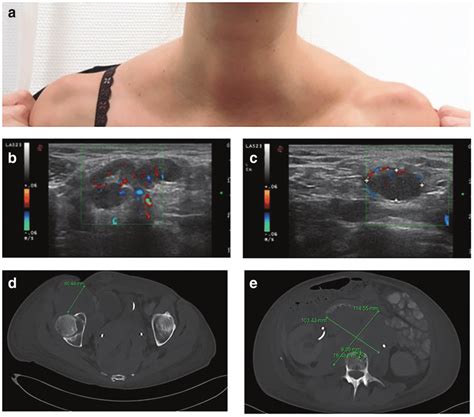 Cervical Lymph Nodes Ultrasound Images And Photos Finder