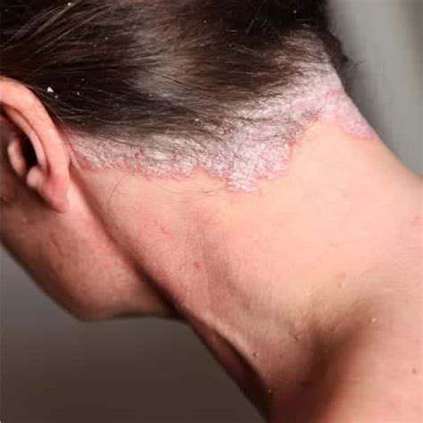 Scalp Psoriasis, Itchy Scalp, Dry Scalp, Tel. Free Advice Line Now