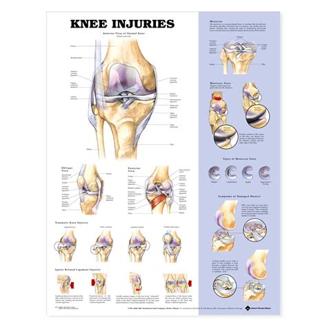 The Knee Injuries Anatomical Charts 20 X 26