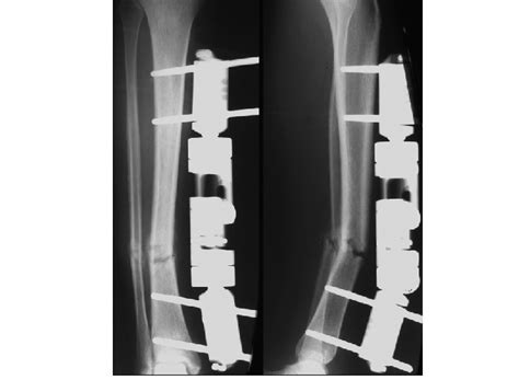 Anteroposterior Left And Lateral Right Radiographs Of The Tibia Six
