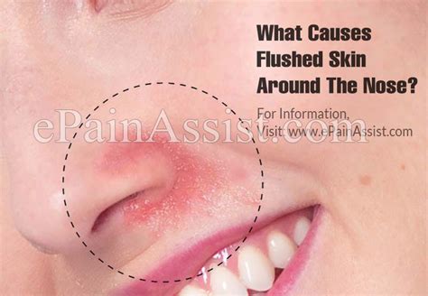What Causes Flushed Skin Around The Nose And How To Treat It