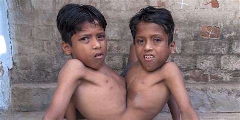 conjoined twins shivanath and shivram sahu perfect the spider walk pictures video huffpost uk