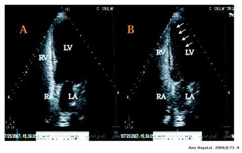 Successful Treatment Of Severe Hepatopulmonary Syndrome With A