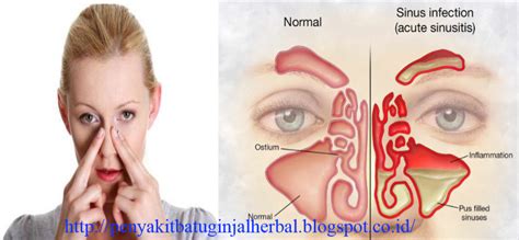 Baru Cara Mengobati Penyakit Batu Ginjal, Obat Sehat